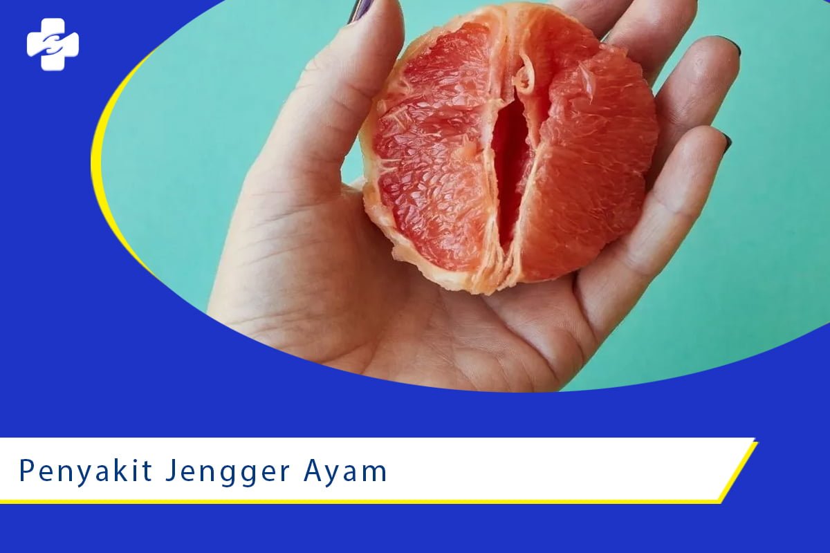 Penyakit Jengger Ayam Definisi Gejala Dan Pencegahannya