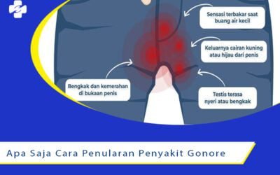 Apa Saja Cara Penularan Penyakit Gonore