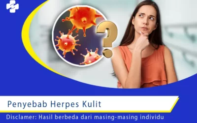 Penyebab dan Cara Pencegahan Herpes Kulit