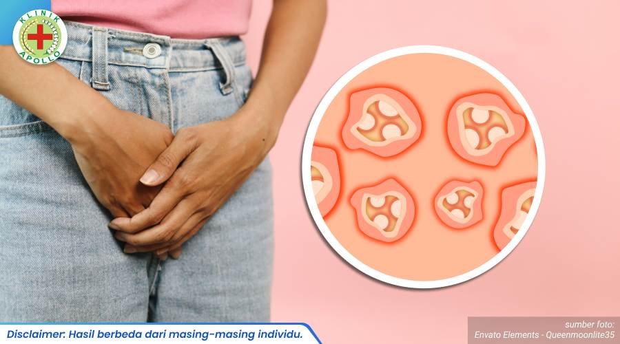 cara menghilangkan kutil kelamin 2_2_11zon