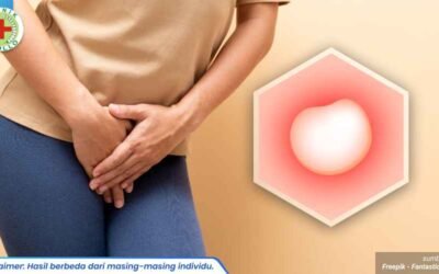 kista bartholin pada remaja 1_4_11zon