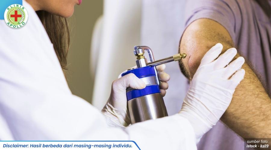 krioterapi kutil kelamin 1_2_11zon