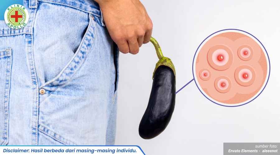 penyebab jerawat di penis 1_3_11zon